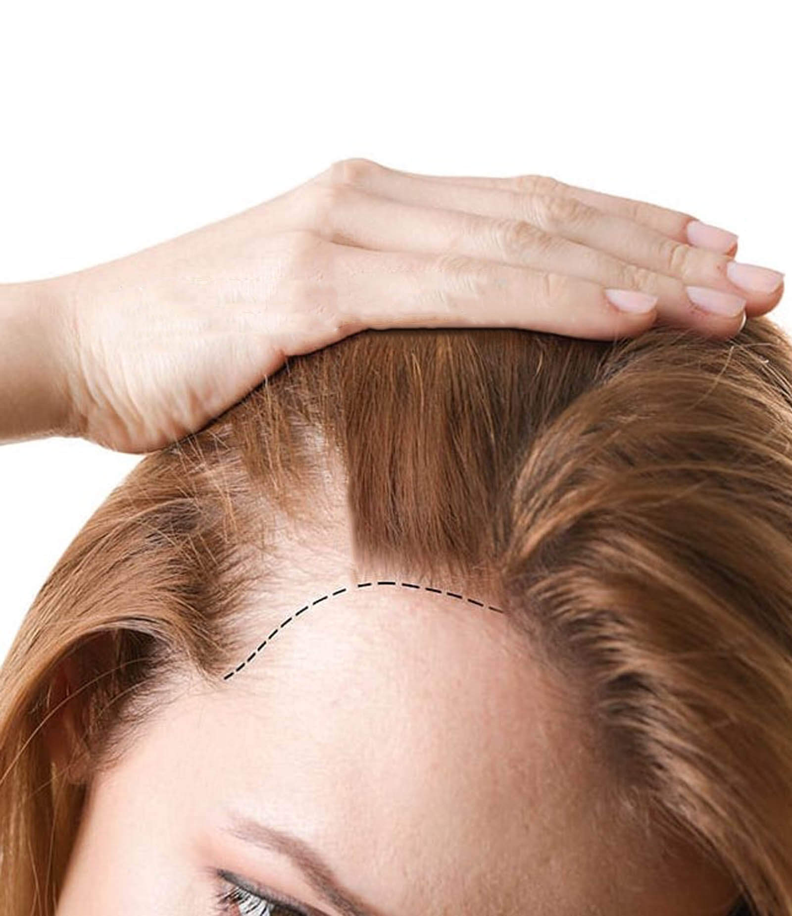 Women Hair Transplant